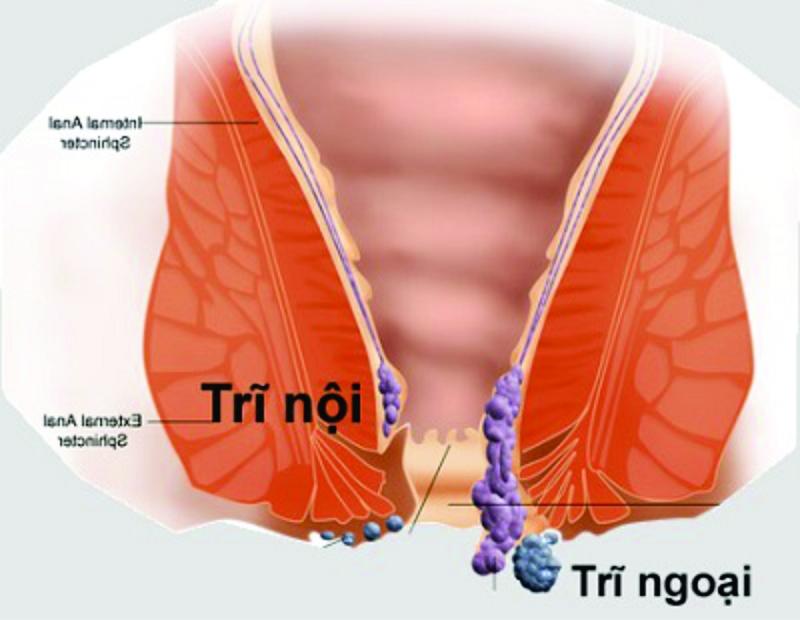 Khi đi ngoài mà phân có máu bạn cũng nên lưu ý, có thể là bệnh trĩ hoặc một cái gì đó vô hại do đi ngoài khó gây rách hậu môn nhưng cũng có thể là dấu hiệu ung thư ruột kết