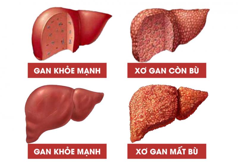 Phân loại xơ gan