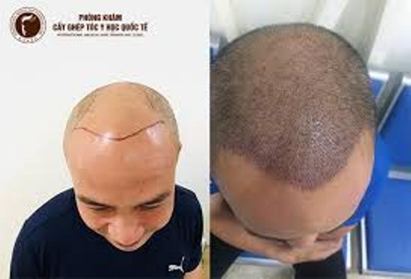 Hình ảnh khách hàng sau khi cấy ghép tóc tại Phòng khám cấy ghép tóc y học Quốc tế