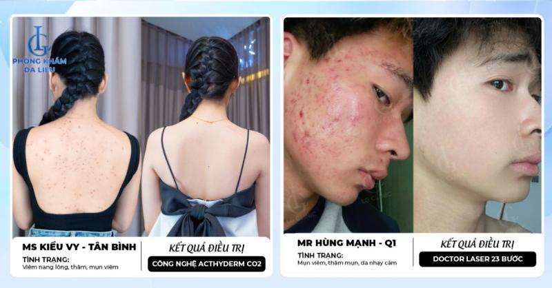 Phòng khám Da liễu LG đã điều trị thành công nhiều ca mụn viêm nặng và mụn lưng dai dẳng