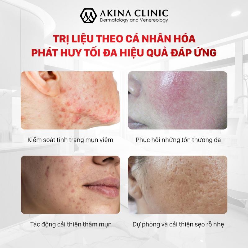 Phòng khám Da liễu Quốc tế AKINA Đà Nẵng - Dr Cao Nguyên