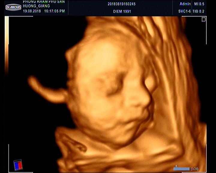 Hãy thưởng thức ảnh siêu âm 4D của chú bé hoạt động vui nhộn trong bụng mẹ, để bạn có thể tận hưởng khoảnh khắc tuyệt vời của cuộc đời này với đứa trẻ của mình.