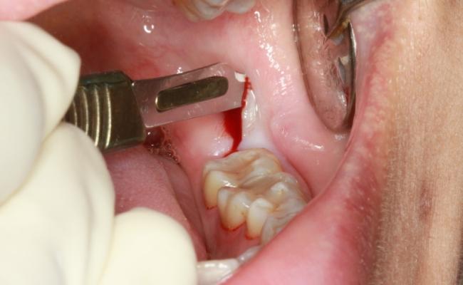 Nha khoa nhổ răng khôn uy tín tại Tp. HCM