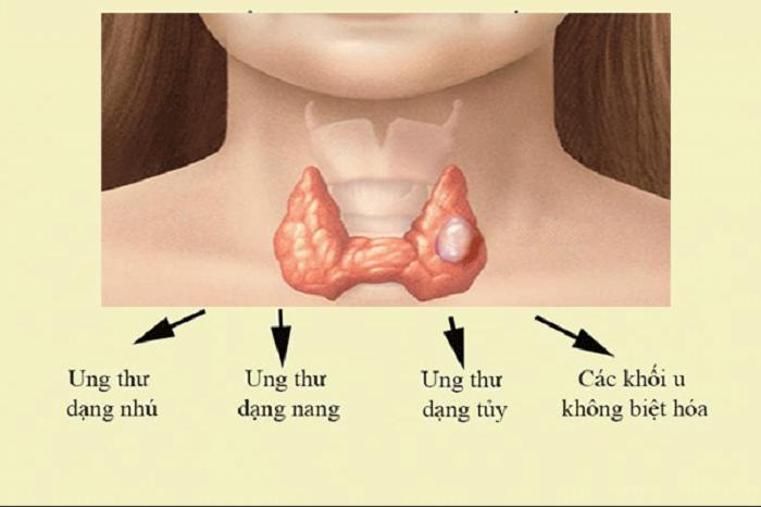 Liệu pháp iốt phóng xạ 131