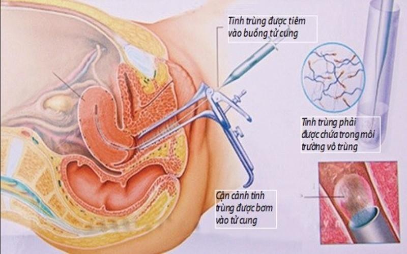 Quá trình bơm tinh trùng vào buồng tử cung