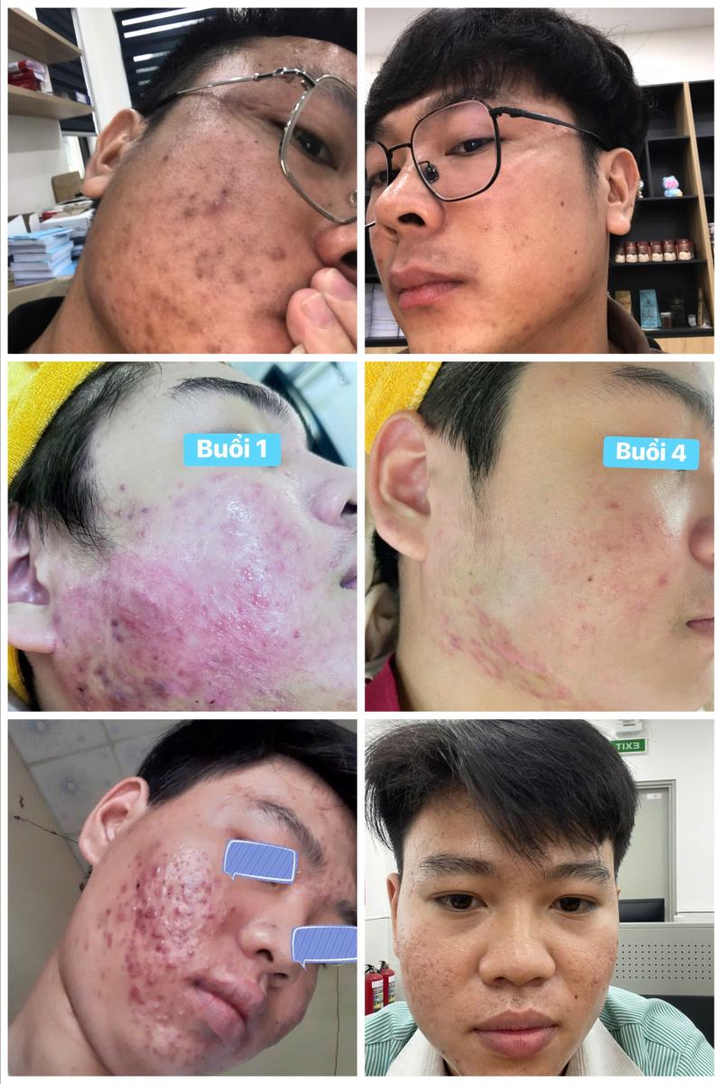 Ảnh khách hàng trị mụn trước và sau tại PT Beauty – Dr. Thanh