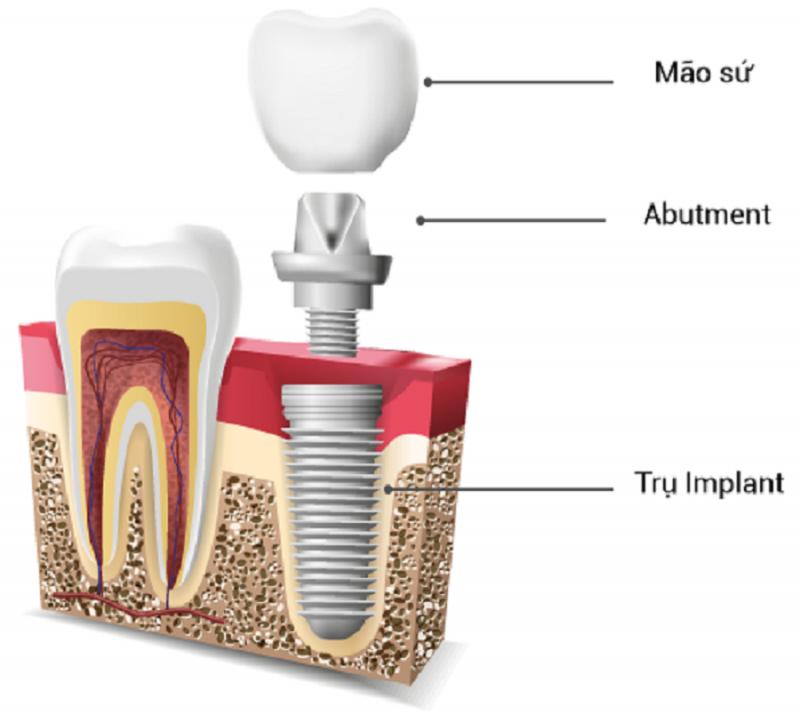 Cấu tạo của răng implant