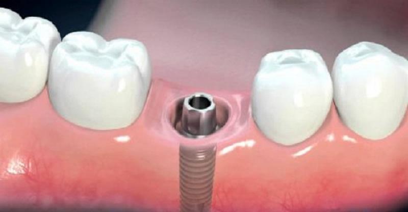 Quy trình trồng răng implant