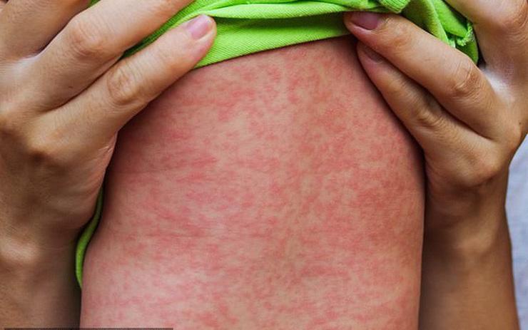 Rubella hay còn gọi là sởi Đức là một bệnh truyền nhiễm do virus rubella gây nên