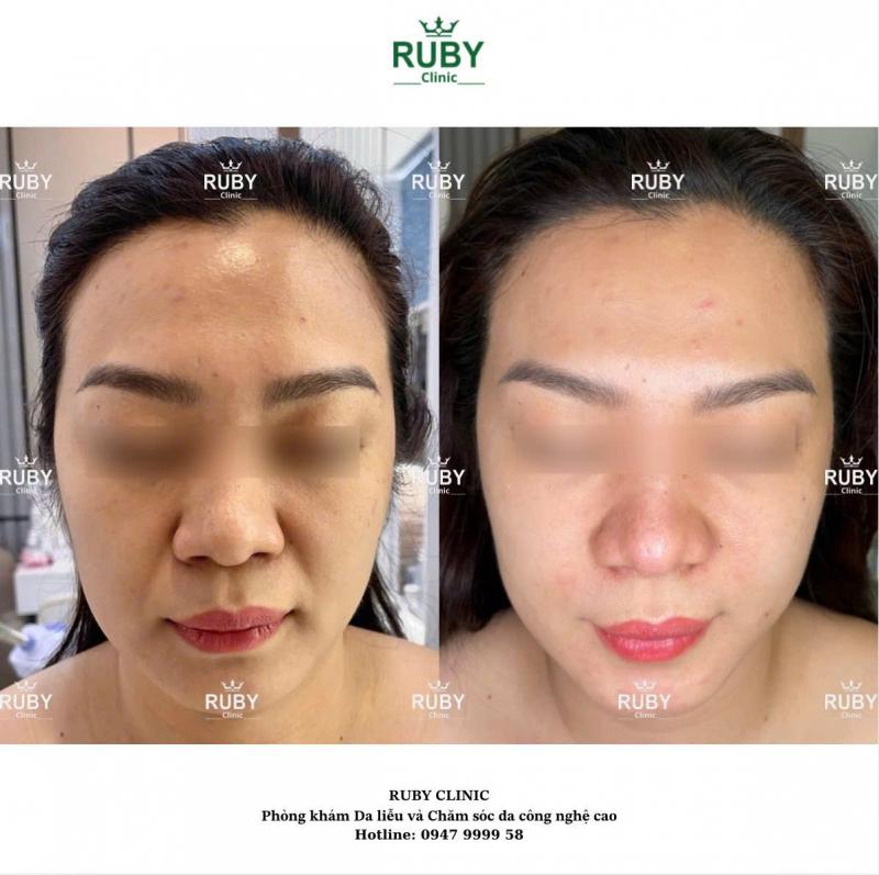 Ruby Clinic-Phòng Khám Da Liễu Và Chăm Sóc Da Công Nghệ Cao
