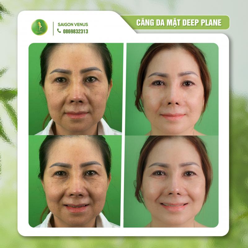 Sài Gòn Venus – Địa Chỉ Căng Da Mặt Deepplane Uy Tín Hàng Đầu TP. HCM