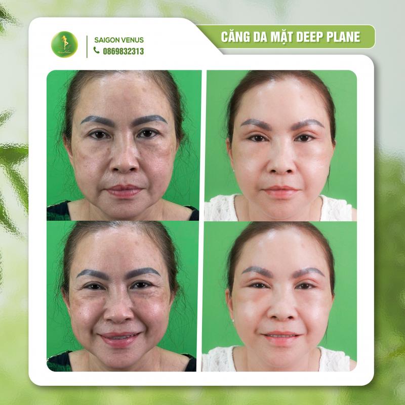 Sài Gòn Venus – Địa Chỉ Căng Da Mặt Deepplane Uy Tín Hàng Đầu TP. HCM