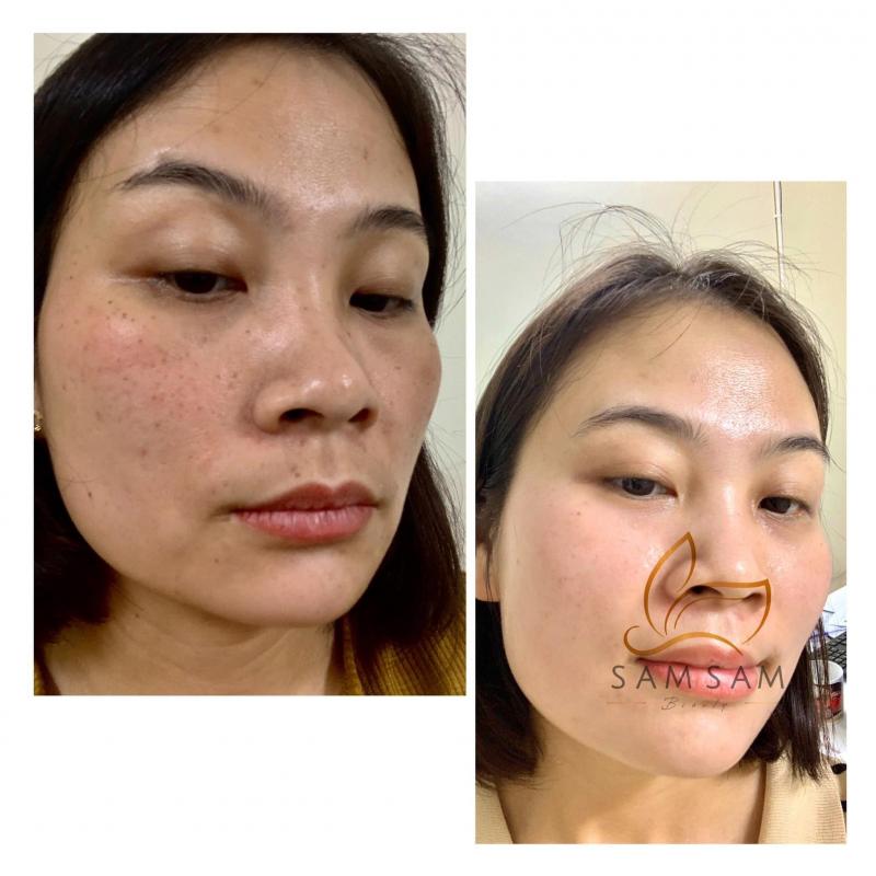 Trị nám tại Sam Sam Beauty