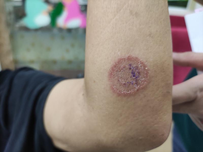 Sản phẩm có công dụng nấm da Ringworm