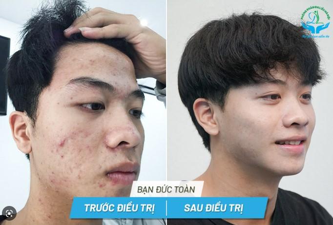 Điều trị mụn tại Phòng Khám Da Liễu Hà Nội