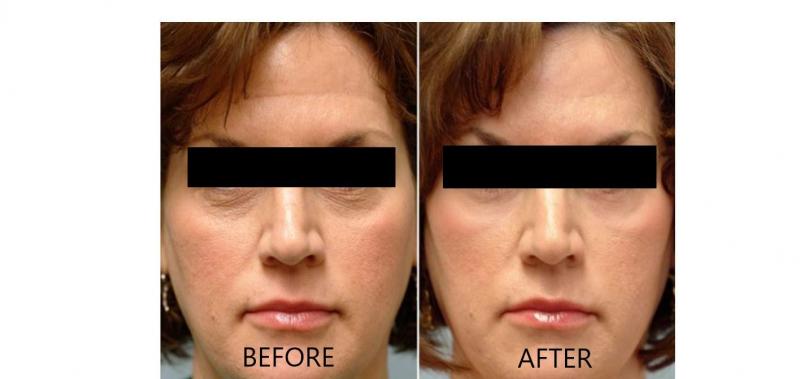 Trước và sau khi sử dụng SkinCeutical Phloretin CF