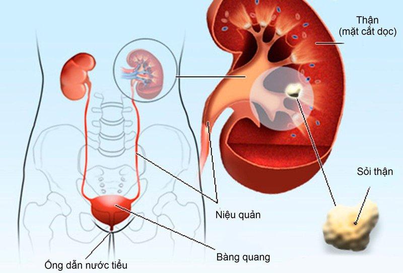 Phòng ngừa bệnh sỏi thận