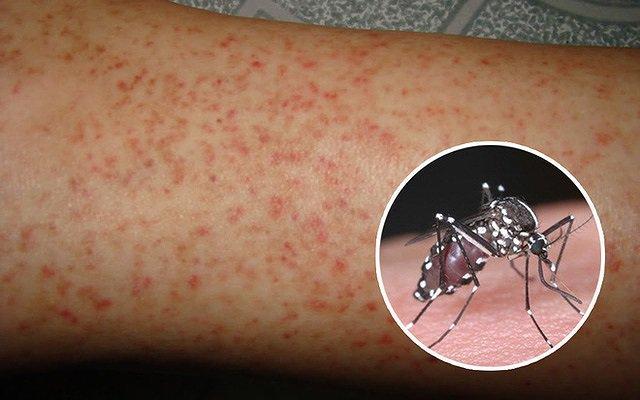 ﻿Sốt xuất huyết là bệnh truyền nhiễm cấp tính do một loại siêu vi trùng có tên là Dengue gây ra