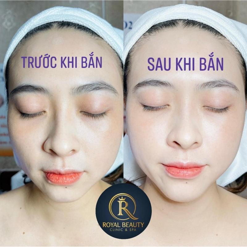 Spa Beauty Royal Nha Trang - Số 1 về Trị Nám