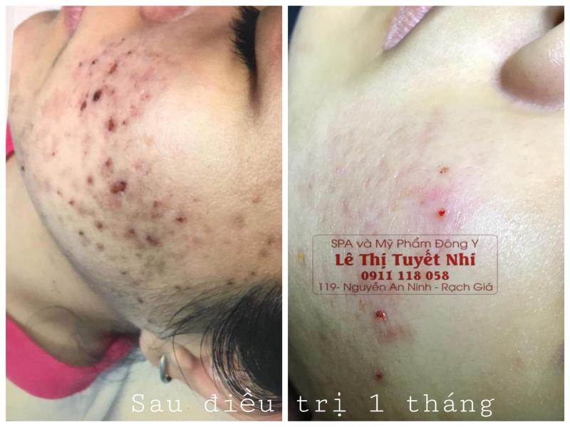 Điều trị mụn tại Spa Đông Y Lê Nhi