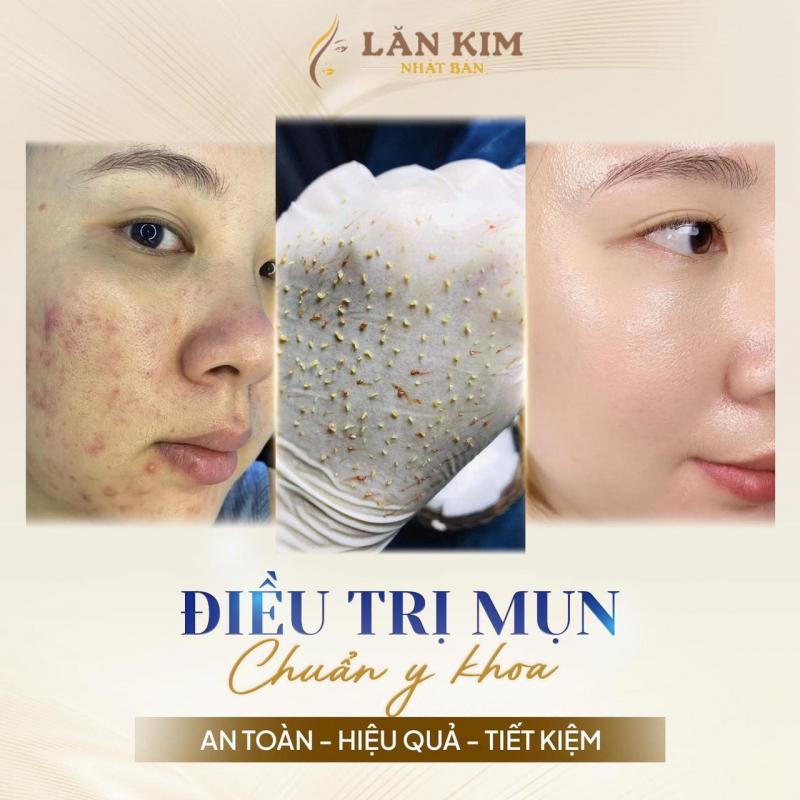 Spa Lăn Kim Nhật Bản