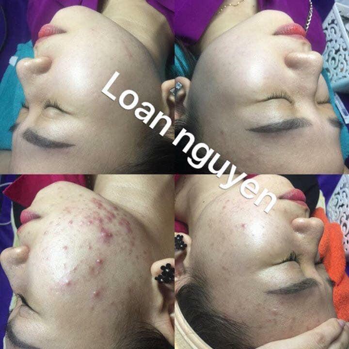 Spa Loan Nguyễn _ Trị Mụn Chuyên Nghiệp Tại Đà Nẵng