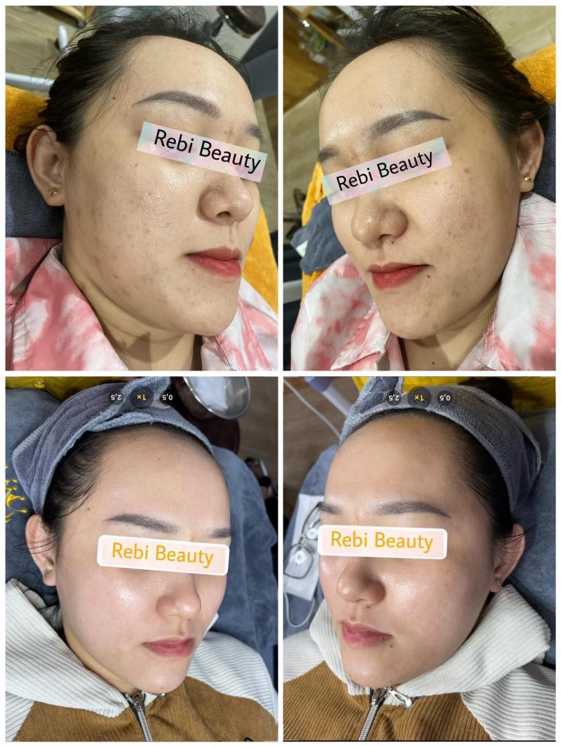 Spa Trị Mụn Rebi Beauty