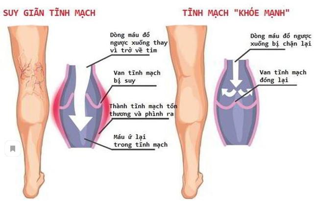 Suy giãn tĩnh mạch là bệnh gì?