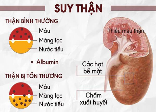 Bệnh suy thận