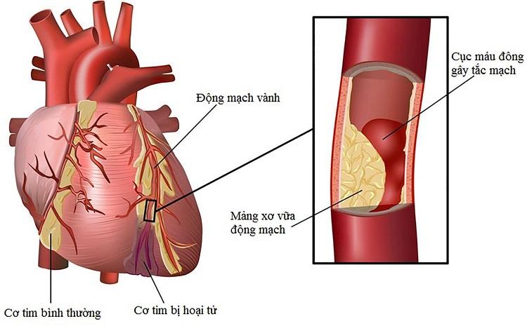 Suy tim gây nhồi máu cơ tim, đột quỵ