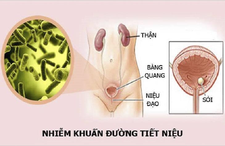 Sản phẩm chỉ định với những bệnh nhân bị nhiễm khuẩn đường tiết niệu