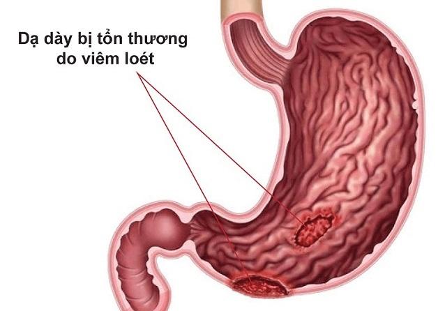 Sản phẩm có thể hỗ trợ điều trị viêm dạ dày