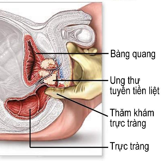 Ngăn ngừa ung thư tuyến tiền liệt