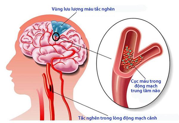 Một nửa số người bị tai biến mạch máu não đều tử vong