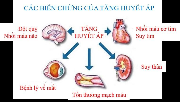 Tăng huyết áp để lại những biến chứng vô cùng nguy hiểm