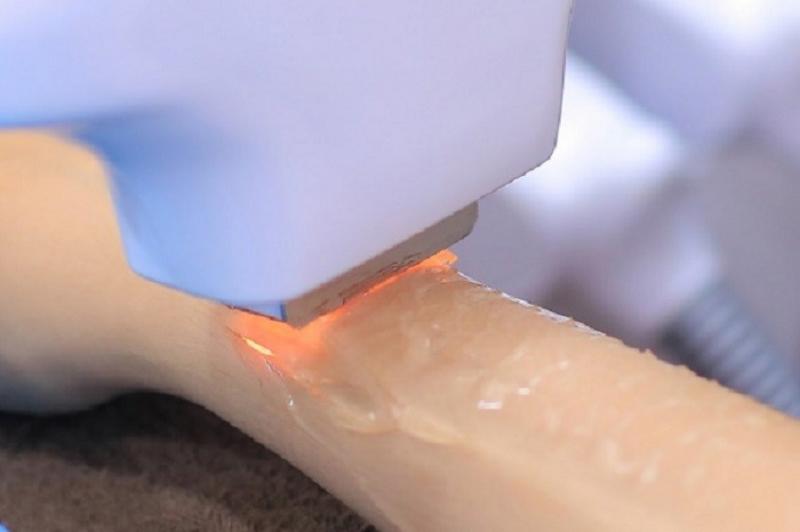 Trước khi triệt lông hãy điều chỉnh đầu phát xung tiếp xúc với da và vuông góc với da