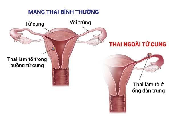 Thai ngoài tử cung có thể đe dọa tính mạng của người mẹ