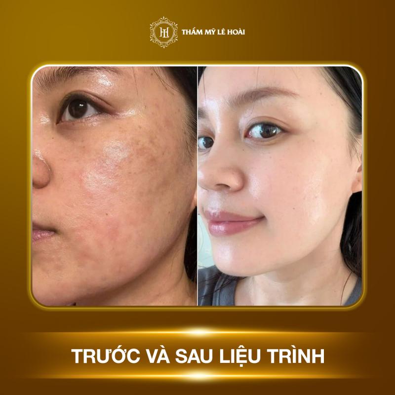 Thẩm Mỹ Lê Hoài - Thiên Đường Chăm Sóc Sắc Đẹp Tại Biên Hoà