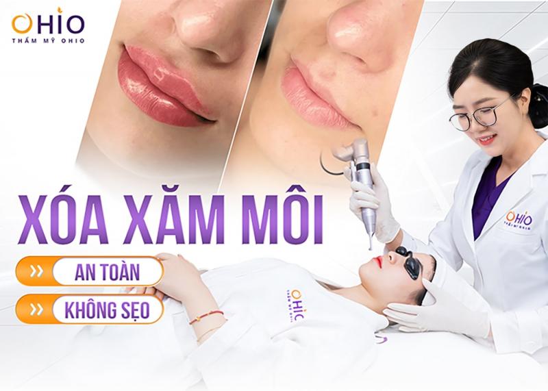 Xóa xăm môi tại Thẩm mỹ OHIO
