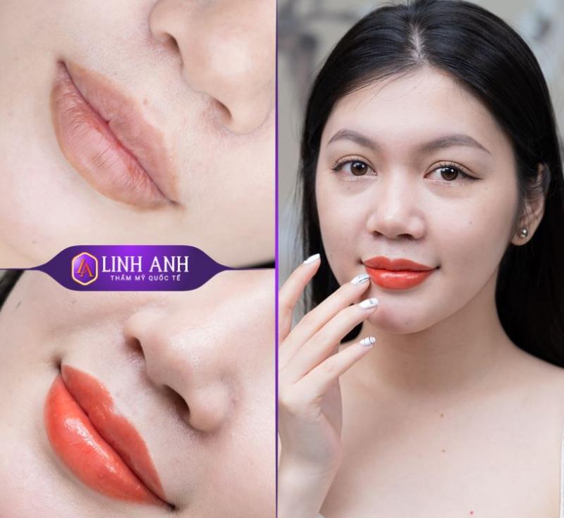 Phun môi Collagen tại thẩm mỹ Quốc Tế Linh Anh - Đà Nẵng