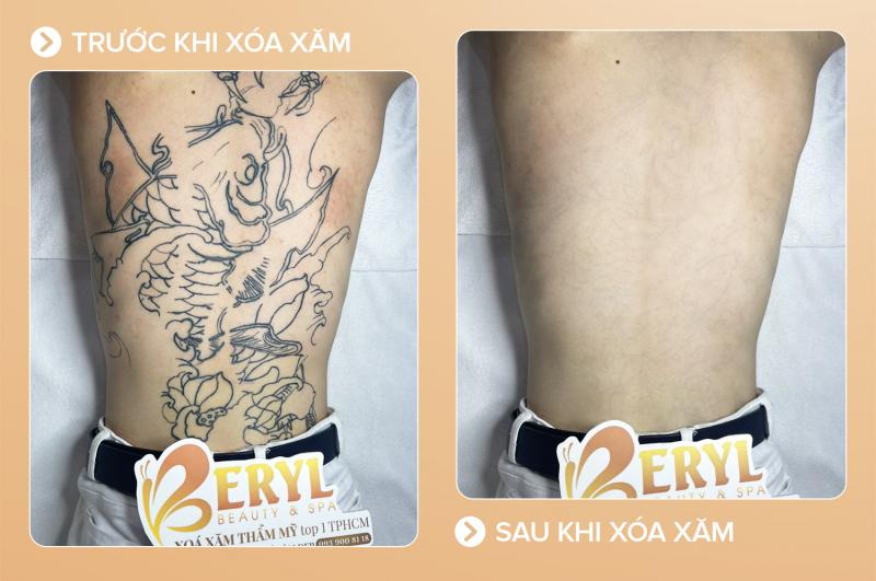 Beryl Beauty & Spa xóa xăm uy tín tại TP. HCM