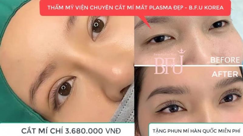 Cắt mí Plasma tại  Thẩm mỹ viện BFU Korea