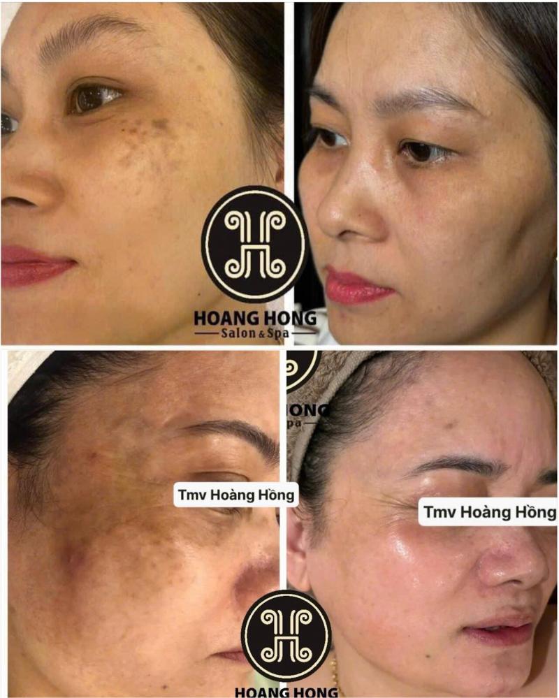 Thẩm mỹ viện Hoàng Hồng - Địa chỉ trị nám Số 1 Ninh Bình