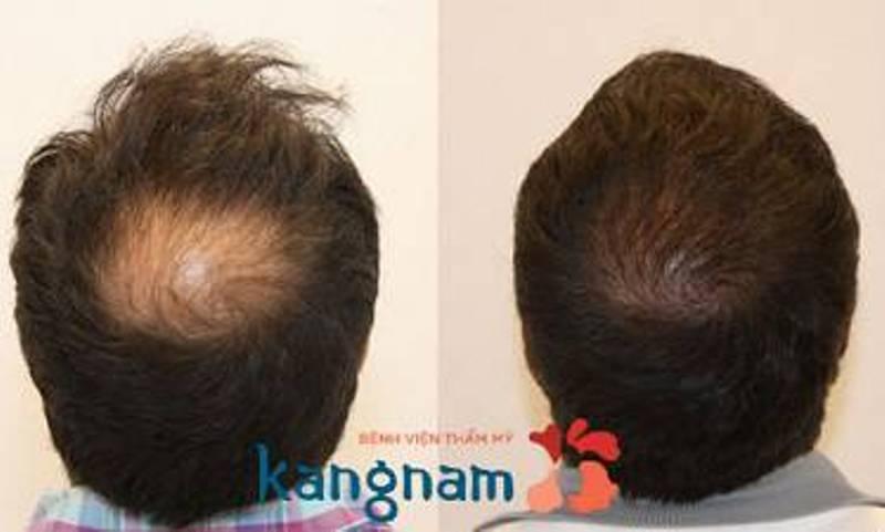 Hình ảnh Cấy Tóc: Cấy tóc FUE 3000 nang, kết quả sau 1 năm - case 71 - Viện Cấy  Tóc Absolute Hair Clinic