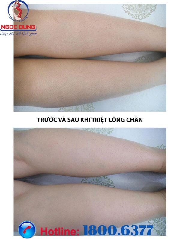 Chân trước và sau khi triệt lông