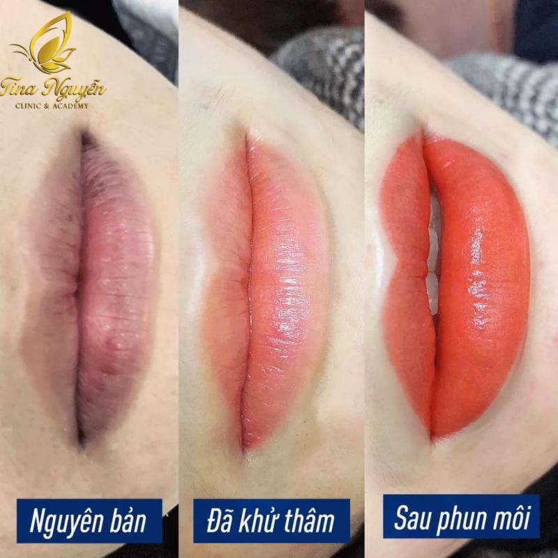 Thẩm Mỹ Viện Tina Nguyễn