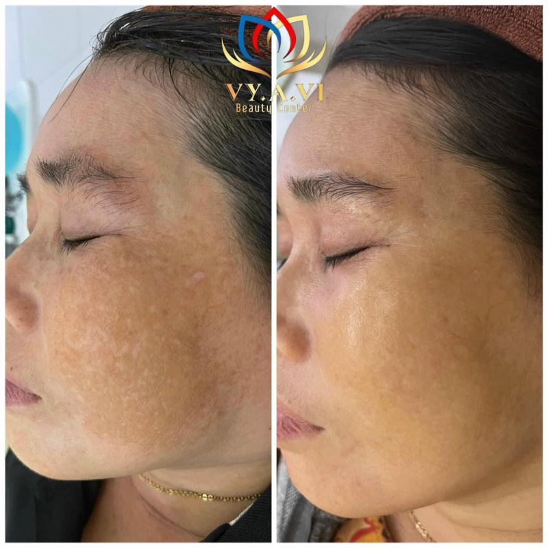 VY.A.VI Spa Bạc Liêu