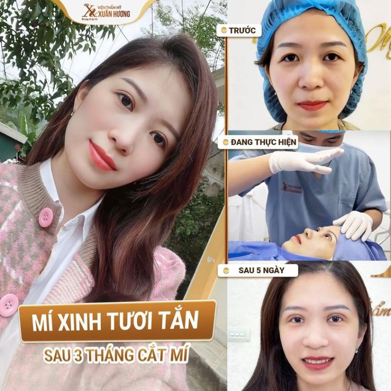 Hình ảnh cắt mí tại Xuân Hương