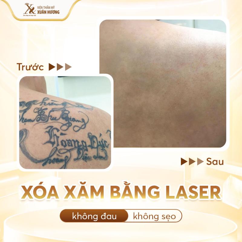 Công nghệ hiện đại tại Xuân Hương, giúp bạn xóa xăm uy tín, an toàn.