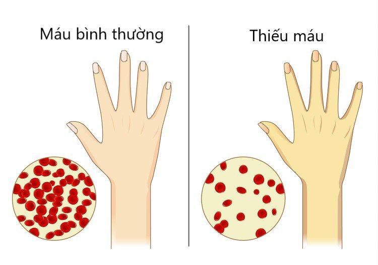 Thiếu máu